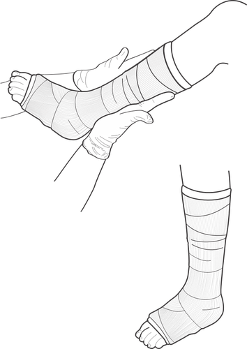 Illustrazione vettoriale della gamba cast esame